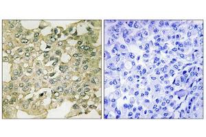 Immunohistochemistry analysis of paraffin-embedded human breast carcinoma tissue using MYT1 (Phospho-Ser83) antibody.