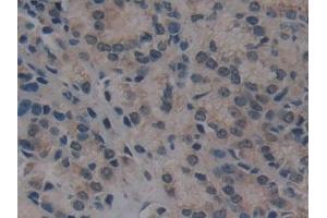 Detection of VIL in Human Prostate cancer Tissue using Polyclonal Antibody to Villin (VIL) (Villin 1 Antikörper  (AA 1-320))