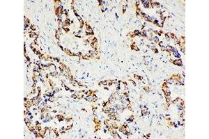 IHC-P: Paxillin antibody testing of human lung cancer tissue (Paxillin Antikörper  (AA 456-472))