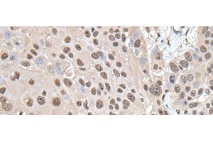 Immunohistochemistry of paraffin-embedded Human esophagus cancer tissue using SMC1A Polyclonal Antibody at dilution of 1:30(x200) (SMC1A Antikörper)