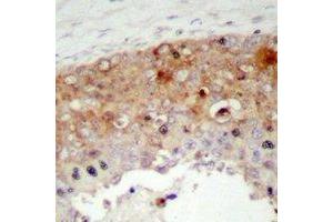 Immunohistochemical analysis of SHCA (pY427) staining in human prostate cancer formalin fixed paraffin embedded tissue section. (SHC1 Antikörper  (pTyr427))
