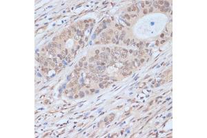 Immunohistochemistry of paraffin-embedded human colon carcinoma using CDK9 antibody (ABIN6129241, ABIN6138331, ABIN6138332 and ABIN6214015) at dilution of 1:100 (40x lens).