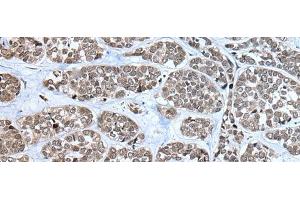 Immunohistochemistry of paraffin-embedded Human esophagus cancer tissue using RPF2 Polyclonal Antibody at dilution of 1:40(x200) (RPF2 Antikörper)