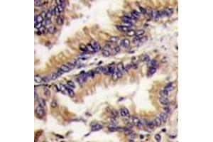 Formalin-fixed and paraffin-embedded human lung carcinoma tissue reacted with MAPK1 Antibody (Center) , which was peroxidase-conjugated to the secondary antibody, followed by DAB staining. (ERK2 Antikörper  (Middle Region))