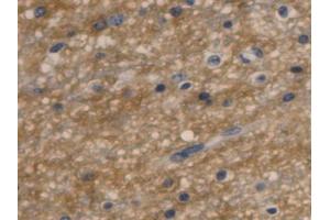 IHC-P analysis of Human Glioma Tissue, with DAB staining. (Aquaporin 4 Antikörper  (AA 178-317))
