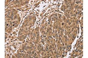 The image on the left is immunohistochemistry of paraffin-embedded Human lung cancer tissue using ABIN7192064(PTPN20A/PTPN20B Antibody) at dilution 1/40, on the right is treated with synthetic peptide. (PTPN2 Antikörper)