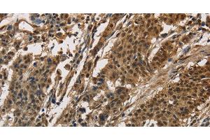 Immunohistochemistry of paraffin-embedded Human gasrtic cancer tissue using CCAR1 Polyclonal Antibody at dilution 1:40 (CCAR1 Antikörper)