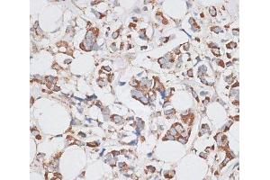 Immunohistochemistry of paraffin-embedded Human breast cancer using KIF14 Polyclonal Antibody at dilution of 1:100 (40x lens). (KIF14 Antikörper)