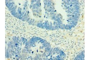 Immunohistochemistry of paraffin-embedded human ovarian cancer using ABIN7160504 at dilution of 1:100 (MEF2C Antikörper  (AA 170-380))