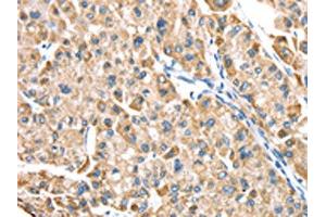 The image on the left is immunohistochemistry of paraffin-embedded Human liver cancer tissue using ABIN7191329(LTB4R2 Antibody) at dilution 1/20, on the right is treated with synthetic peptide. (LTB4R2 Antikörper)
