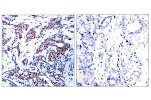 Immunohistochemical analysis of paraffin-embedded human breast carcinoma tissue using c-Jun(Phospho-Ser73) Antibody(left) or the same antibody preincubated with blocking peptide(right). (C-JUN Antikörper  (pSer73))