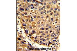 Formalin-fixed and paraffin-embedded human hepatocarcinoma reacted with SPCS3 Antibody , which was peroxidase-conjugated to the secondary antibody, followed by DAB staining. (SPCS3 Antikörper  (C-Term))