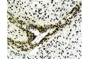 Immunohistochemiacl staining of human gastric carcinoma tissue section with CYC1 polyclonal antibody  at 1:500 dilution. (Cytochrome C1 Antikörper)