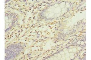 Immunohistochemistry of paraffin-embedded human colon cancer using ABIN7175519 at dilution of 1:100 (Vinexin Antikörper  (AA 1-329))