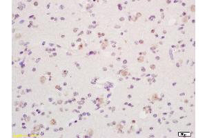 Formalin-fixed and paraffin embedded human glioma tissue labeled with Anti phospho-Dnmt1(Ser154) Polyclonal Antibody, Unconjugated (ABIN757717) at 1:200 followed by conjugation to the secondary antibody and DAB staining (DNMT1 Antikörper  (pSer154))
