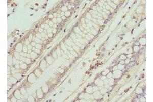 Immunohistochemistry of paraffin-embedded human colon cancer using ABIN7156584 at dilution of 1:100 (IFNB1 Antikörper  (AA 22-187))