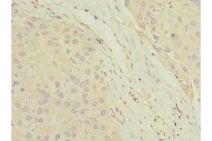 Immunohistochemistry of paraffin-embedded human liver cancer using ABIN7154846 at dilution of 1:100 (HAND2 Antikörper  (AA 1-217))