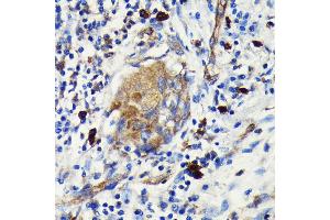 Immunohistochemistry of paraffin-embedded human lung cancer using Argonaute-2 antibody (ABIN7265671) at dilution of 1:100 (40x lens). (AGO2 Antikörper)
