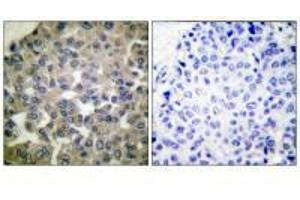 Immunohistochemical analysis of paraffin-embedded human breast carcinoma tissue using PLCG1 (Ab-771) antibody. (Phospholipase C gamma 1 Antikörper  (Tyr771))