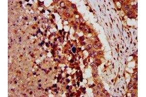 IHC image of ABIN7149298 diluted at 1:300 and staining in paraffin-embedded human lung cancer performed on a Leica BondTM system. (CRLF1 Antikörper  (AA 318-422))