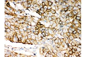 Anti-ALDH1A1 antibody, IHC(P) IHC(P): Human Lung Cancer Tissue
