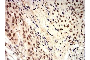Immunohistochemical analysis of paraffin-embedded esophageal cancer tissues using ROP1 mouse mAb with DAB staining.