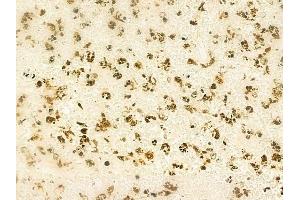 ABIN6261227 and ABIN6268967 at 1/100 staining human melanoma by IHC-P. (DAXX Antikörper  (C-Term))