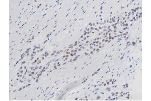 ABIN6267508 at 1/200 staining Human bladder cancer tissue sections by IHC-P. (STAT1 Antikörper  (pSer727))
