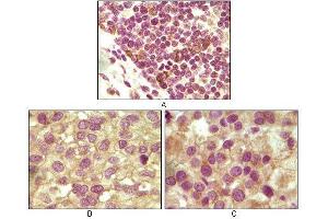 Immunohistochemical analysis of paraffin-embedded human lymphoid (A), ovary tumor (B) and testicle tumor (C) tissues using INHA mouse mAb with DAB staining. (Inhibin alpha Antikörper)