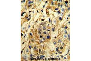 Formalin-fixed and paraffin-embedded human breast carcionma reacted with TIMP1 Antibody (N-term), which was peroxidase-conjugated to the secondary antibody, followed by DAB staining.