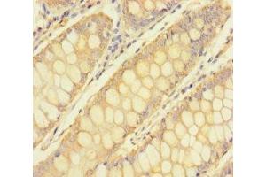 Immunohistochemistry of paraffin-embedded human colon cancer using ABIN7173639 at dilution of 1:100 (TULP3 Antikörper  (AA 1-260))