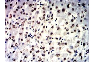 Immunohistochemical analysis of paraffin-embedded liver cancer tissues using IL1B mouse mAb with DAB staining. (IL-1 beta Antikörper  (AA 117-269))