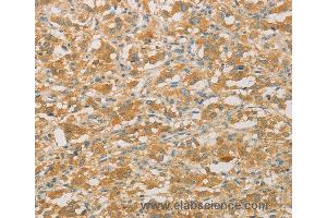Immunohistochemistry of Human gastric cancer using PRPSAP1 Polyclonal Antibody at dilution of 1:50 (PRPSAP1 Antikörper)