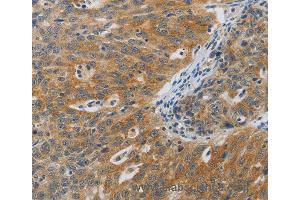 Immunohistochemistry of Human ovarian cancer using F2R Polyclonal Antibody at dilution of 1:40