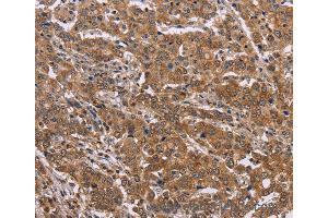 Immunohistochemistry of Human colon cancer using FAAH2 Polyclonal Antibody at dilution of 1:30 (FAAH2 Antikörper)