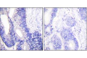 Immunohistochemical analysis of paraffin-embedded human colon carcinoma tissue using Claudin 3 antibody.