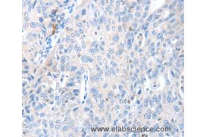 Immunohistochemistry of Human ovarian cancer using MAGEB4 Polyclonal Antibody at dilution of 1:40 (MAGEB4 Antikörper)