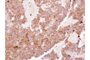 IHC-P Image Immunohistochemical analysis of paraffin-embedded HUH7 xenograft, using EIF3 zeta, antibody at 1:100 dilution. (EIF3D Antikörper)