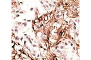 IHC analysis of FFPE human breast carcinoma tissue stained with the LC3C antibody (LC3C Antikörper  (AA 1-30))