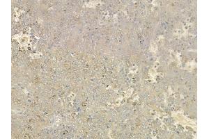 ABIN6261032 and ABIN6276527 at 1/100 staining human melanoma by IHC-P.