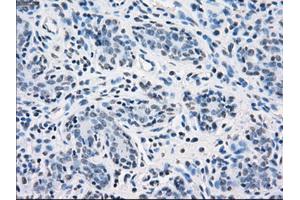 Immunohistochemical staining of paraffin-embedded breast tissue using anti-SORD mouse monoclonal antibody. (SORD Antikörper)