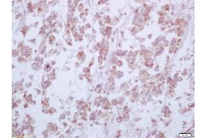 Formalin-fixed and paraffin embedded human liver carcinoma labeled with Anti-Arginase 1 Polyclonal Antibody, Unconjugated  at 1:200 followed by conjugation to the secondary antibody and DAB staining (Liver Arginase Antikörper  (AA 151-220))