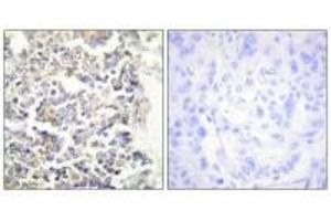Immunohistochemistry analysis of paraffin-embedded human lung carcinoma tissue using MARK3 antibody. (MARK3 Antikörper  (N-Term))