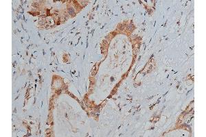 ABIN6255078 and ABIN6267287 at 1/50 staining human lung cancer tissue sections by IHC-P.