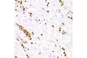 Immunohistochemistry of paraffin-embedded human gastric cancer using RAD50 Antibody. (RAD50 Antikörper)