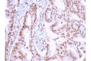 Formalin-fixed, paraffin-embedded human Breast Carcinoma stained with CLEC9A Mouse Monoclonal Antibody (2H12/4). (DMC1 Antikörper)