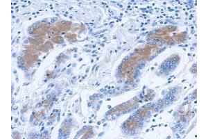 IHC-P Image Immunohistochemical analysis of paraffin-embedded human colon carcinoma, using Annexin II antibody, antibody at 1:500 dilution. (Annexin A2 Antikörper)