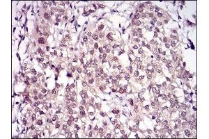 Immunohistochemical analysis of paraffin-embedded human bladder cancer tissues using RANBP9 mouse mAb with DAB staining. (Importin 9 Antikörper  (AA 453-680))