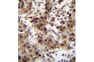 ZNF321 Antibody (N-term) immunohistochemistry analysis in formalin fixed and paraffin embedded human breast carcinoma followed by peroxidase conjugation of the secondary antibody and DAB staining. (ZNF321P Antikörper  (N-Term))