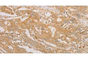 Immunohistochemistry of paraffin-embedded Human gastric cancer tissue using CD40 Polyclonal Antibody at dilution 1:70 (CD40 Antikörper)